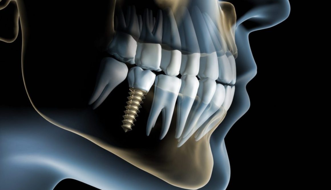 Lucruri importante pe care trebuie sa le știe orice persoana care vrea sa isi puna un implant dentar